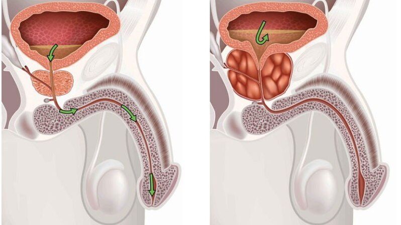 healthy, inflamed prostate gland with prostatitis